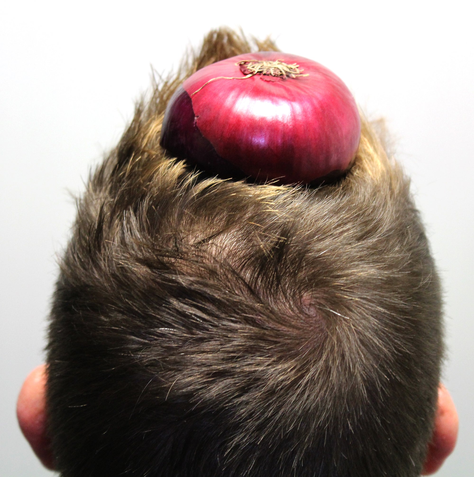 Is Onion Juice a hair growth remedy?