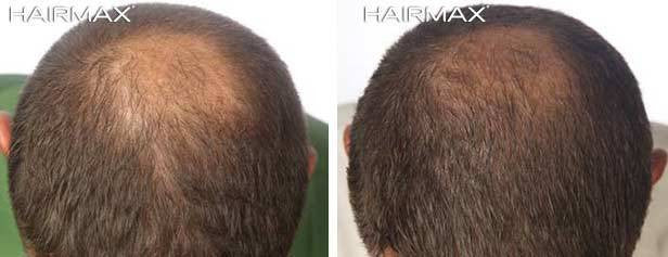 Have you ever wondered why as we age, hair can become thinner and finer